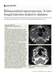 Rhinocerebral mucormycosis: A rare fungal infection linked to diabetes case	report
