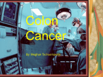 Colon Cancer