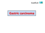 Gastric cancer