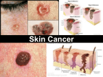 Skin Cancer powerpoint