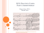 ECG Practice Cases: Part 2 Arrythmias