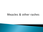 Measles & other rashes