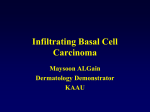 Infiltrating Basal Cell Carcinoma