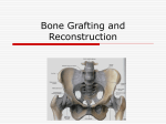 Bone Grafting