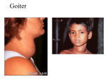 Goiter