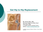 Get Hip to Hip Replacement