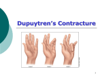 Dupuytren’s Contracture