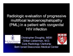 Radiologic Evaluation Of Progressive Multifocal Leukoencephalopathy (PML) In A Patient With Congenital HIV Infection