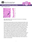 – Ectopic neuron Nerve