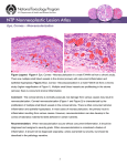 Eye, Cornea – Neovascularization