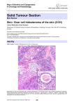 Solid Tumour Section Skin: Clear cell hidradenoma of the skin (CCH)