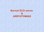 ecg-arryhthmias