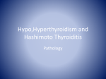 Hashimoto thyroiditis