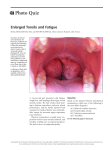 Enlarged Tonsils and Fatigue