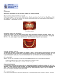 Retainers - Lakeside Orthodontics