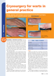 Cryosurgery for warts in general practice