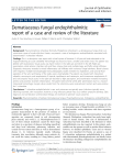 Dematiaceous fungal endophthalmitis: report of