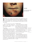 Impetigo - Boston Health Care for the Homeless Program