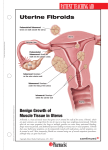 Uterine Fibroids