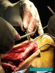 US Air Force surgeons repair the ruptured achilles tendon of a