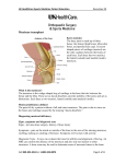 Meniscus Transplant