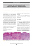 Exuberant skin involvement in Systemic Lupus Erythematosus
