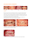 DRUG-INDUCED GINGIVAL OVERGROWTH