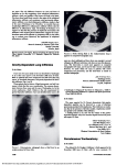 Gravity-Dependent Lung Infiltrates