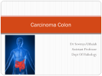 Colon carcinoma