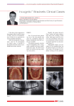 Incognito™ Brackets: Clinical Cases