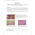 Purplish Papules and Plaques with Blisters on Lower Lip