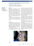 A case of non-resolving subconjunctival cysticercosis managed by